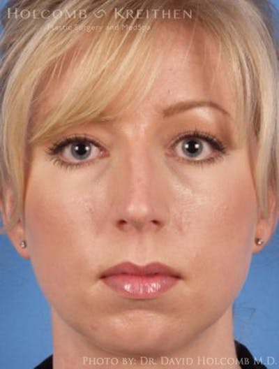 Rhinoplasty Before & After Gallery - Patient 6279331 - Image 1