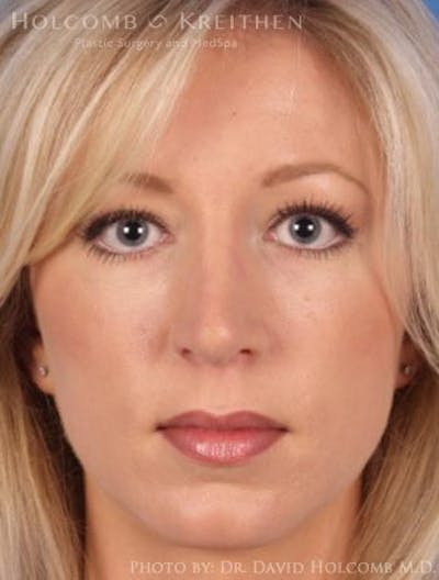 Rhinoplasty Before & After Gallery - Patient 6279331 - Image 2