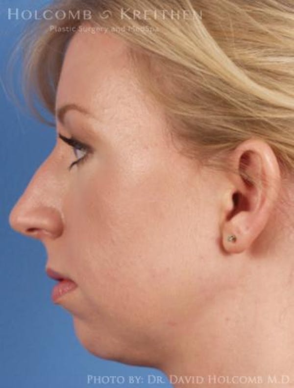 Rhinoplasty Before & After Gallery - Patient 6279331 - Image 5