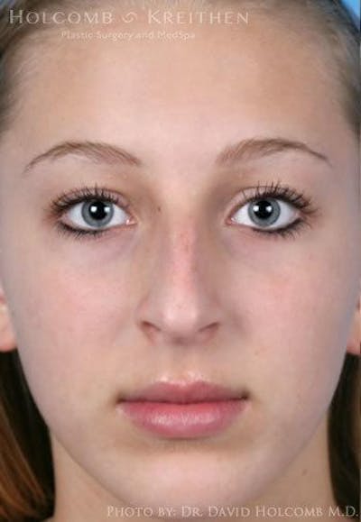 Rhinoplasty Before & After Gallery - Patient 6279335 - Image 1