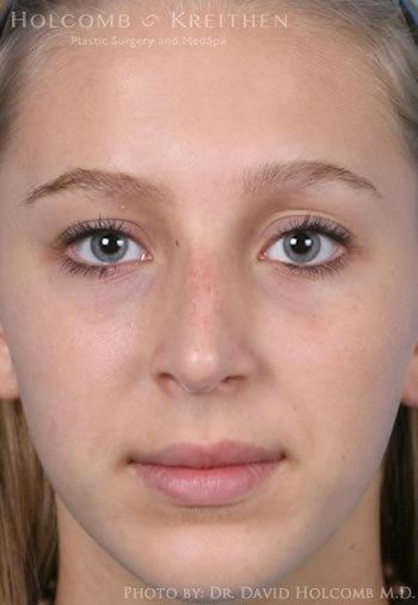 Rhinoplasty Before & After Gallery - Patient 6279335 - Image 2