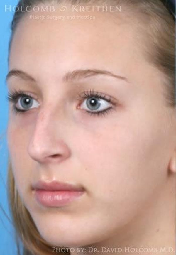 Rhinoplasty Before & After Gallery - Patient 6279335 - Image 3