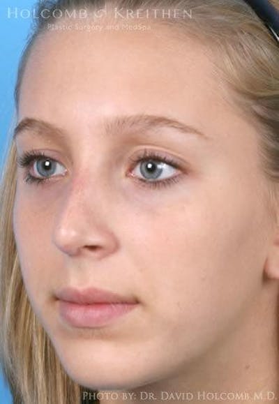 Rhinoplasty Before & After Gallery - Patient 6279335 - Image 4