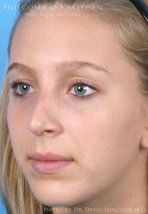 Rhinoplasty Before & After Gallery - Patient 6279335 - Image 4