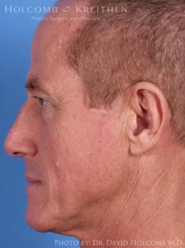 Neck Contouring Before & After Gallery - Patient 6279333 - Image 5