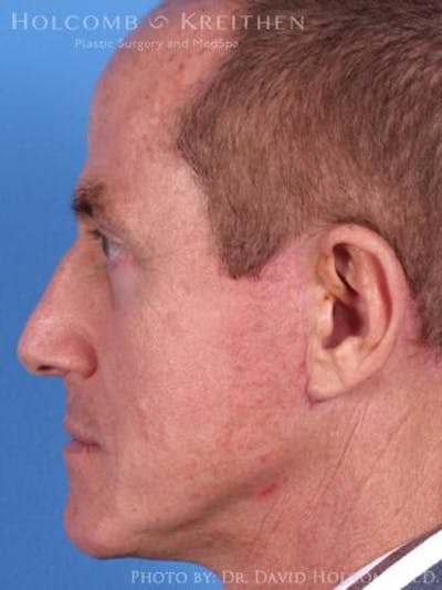 Neck Contouring Gallery - Patient 6279333 - Image 6