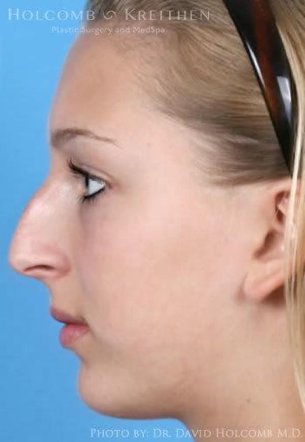 Rhinoplasty Before & After Gallery - Patient 6279335 - Image 5