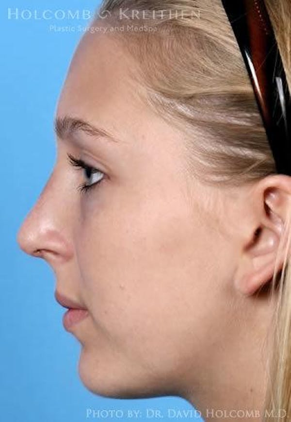 Rhinoplasty Before & After Gallery - Patient 6279335 - Image 6