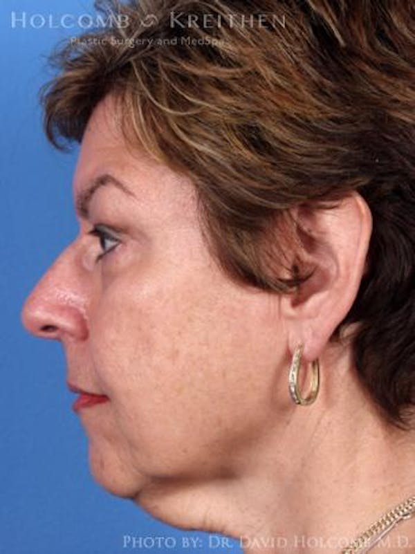 Neck Contouring Before & After Gallery - Patient 6279337 - Image 5