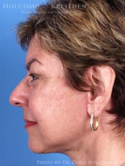 Neck Contouring Gallery - Patient 6279337 - Image 6
