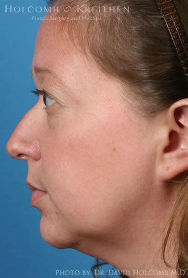 Rhinoplasty Before & After Gallery - Patient 6279341 - Image 5