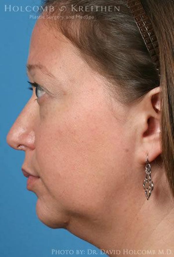 Rhinoplasty Before & After Gallery - Patient 6279341 - Image 6