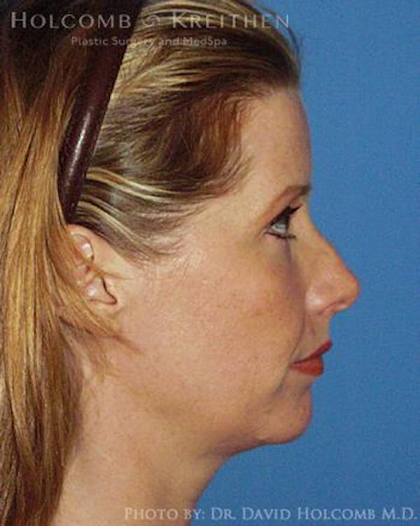 Neck Contouring Before & After Gallery - Patient 6279357 - Image 5