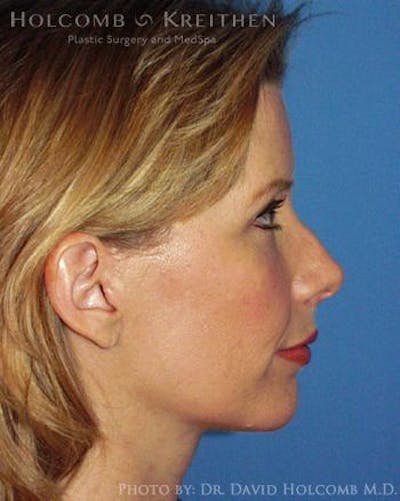 Neck Contouring Before & After Gallery - Patient 6279357 - Image 6