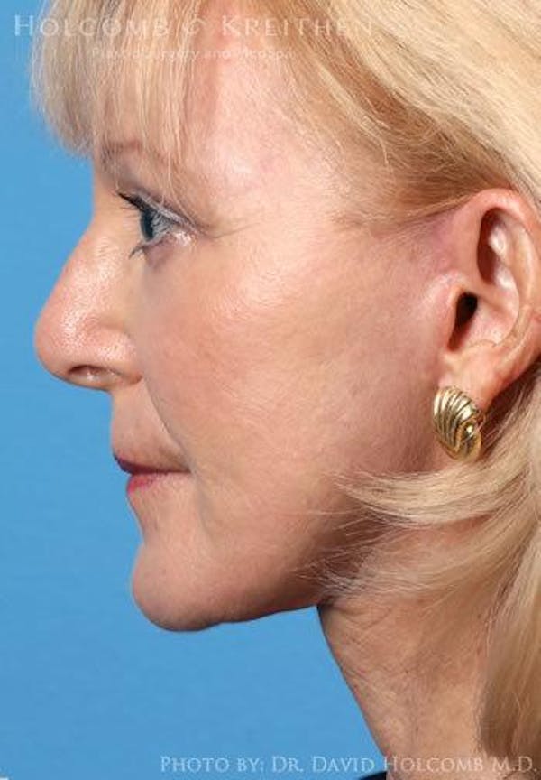 Neck Contouring Before & After Gallery - Patient 6279358 - Image 6
