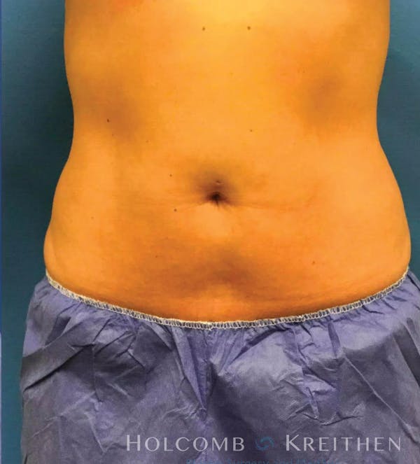 Coolsculpting Before & After Gallery - Patient 6279391 - Image 2