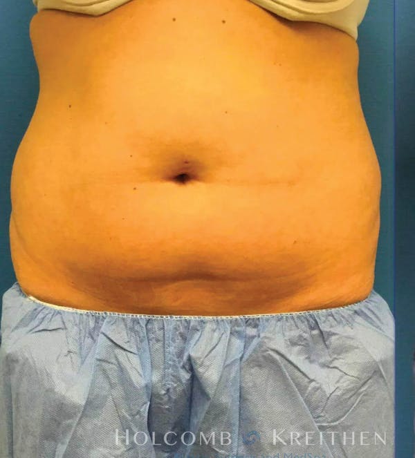 Coolsculpting Before & After Gallery - Patient 6279391 - Image 1