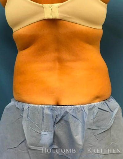 Coolsculpting Before & After Gallery - Patient 6279391 - Image 4