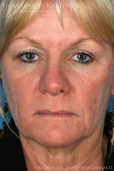 AccuLift Before & After Gallery - Patient 6279392 - Image 1