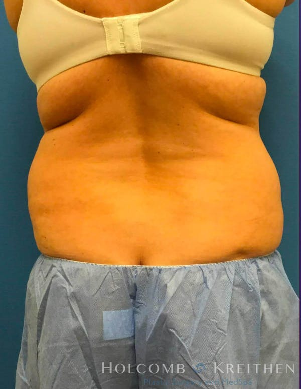 Coolsculpting Before & After Gallery - Patient 6279391 - Image 3