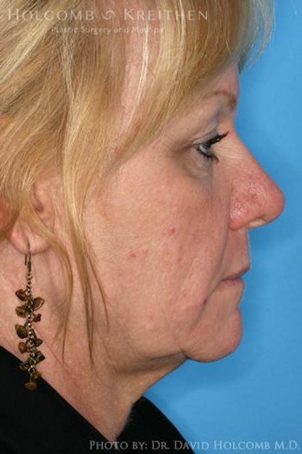AccuLift Before & After Gallery - Patient 6279392 - Image 3