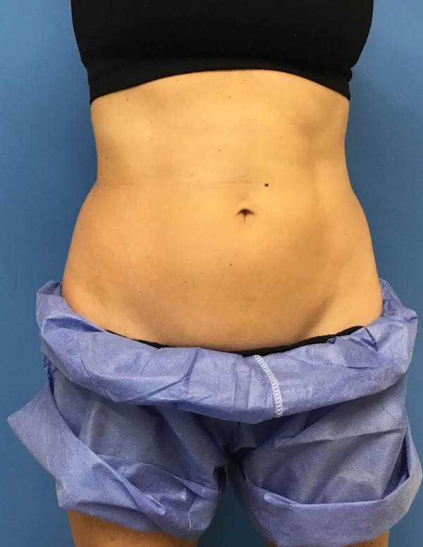 Coolsculpting Before & After Gallery - Patient 6279396 - Image 2