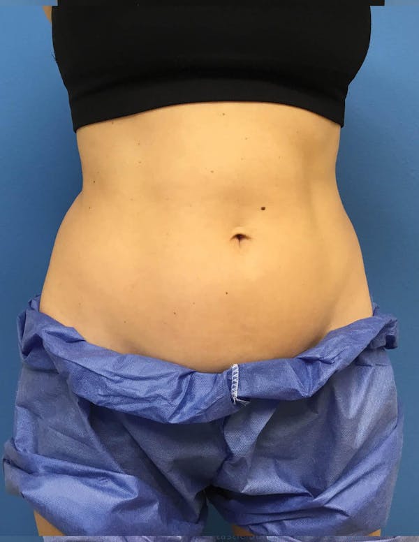 Coolsculpting Before & After Gallery - Patient 6279396 - Image 1