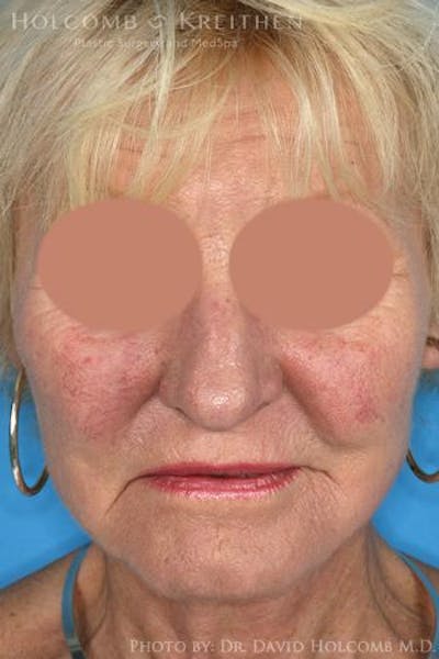 AccuLift Before & After Gallery - Patient 6279393 - Image 2