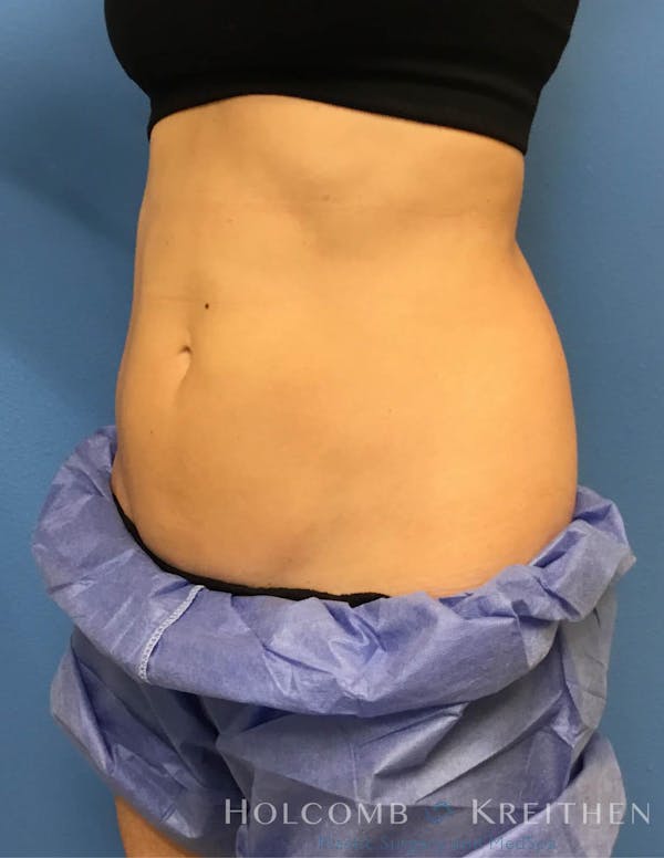 Coolsculpting Before & After Gallery - Patient 6279396 - Image 4