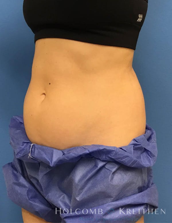 Coolsculpting Gallery - Patient 6279396 - Image 3
