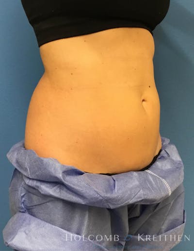 Coolsculpting Gallery - Patient 6279396 - Image 6
