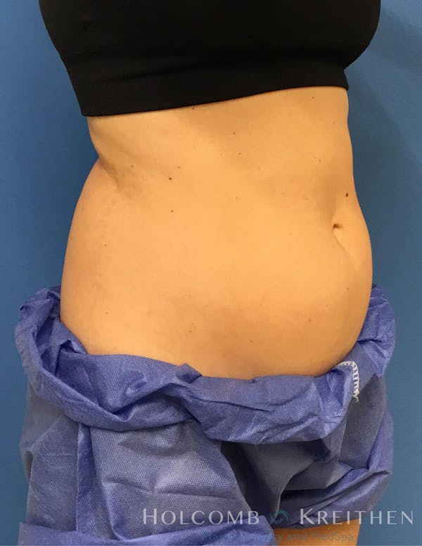 Coolsculpting Gallery - Patient 6279396 - Image 5