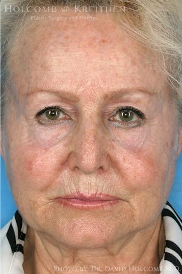 AccuLift Before & After Gallery - Patient 6279395 - Image 3