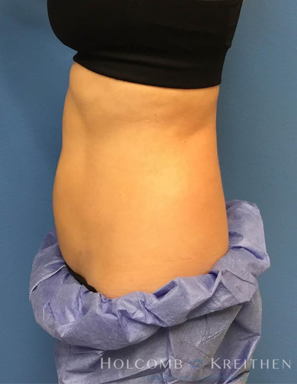 Coolsculpting Before & After Gallery - Patient 6279396 - Image 8