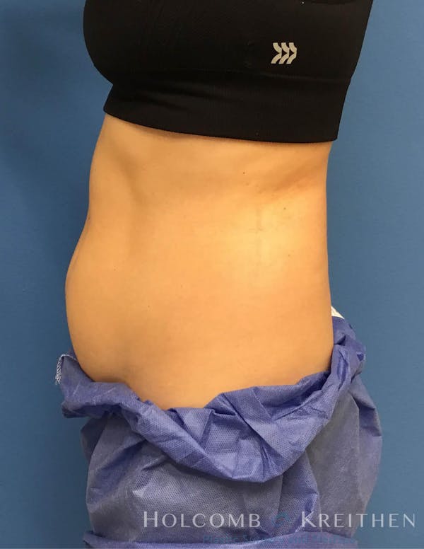 Coolsculpting Gallery - Patient 6279396 - Image 7