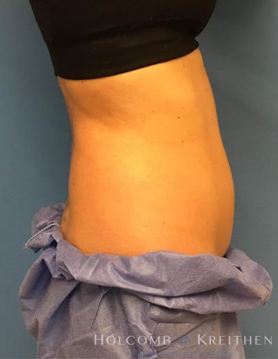 Coolsculpting Before & After Gallery - Patient 6279396 - Image 10