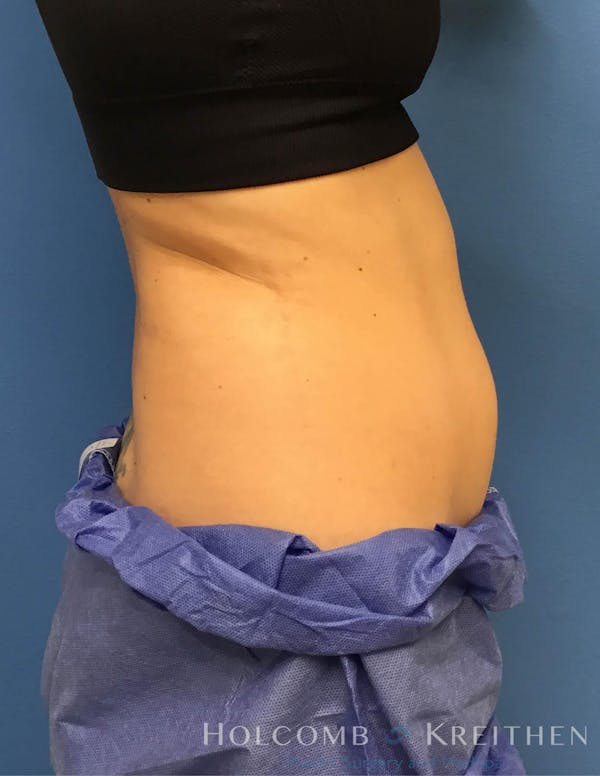 Coolsculpting Before & After Gallery - Patient 6279396 - Image 9