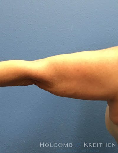 Coolsculpting Before & After Gallery - Patient 6279398 - Image 2