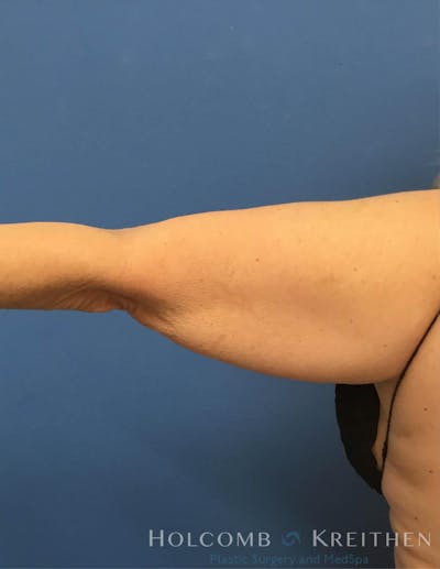 Coolsculpting Before & After Gallery - Patient 6279398 - Image 1