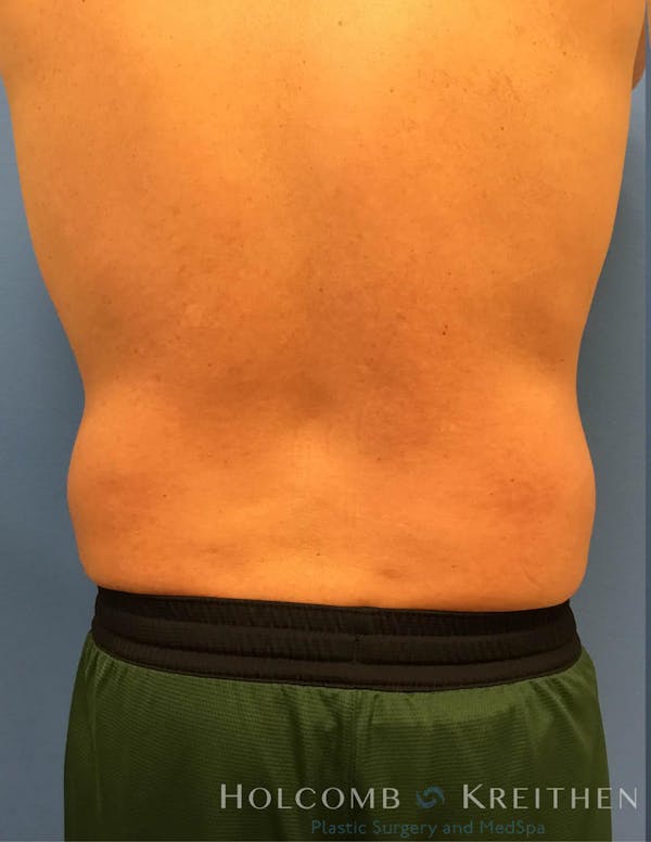 Coolsculpting Before & After Gallery - Patient 6279399 - Image 1