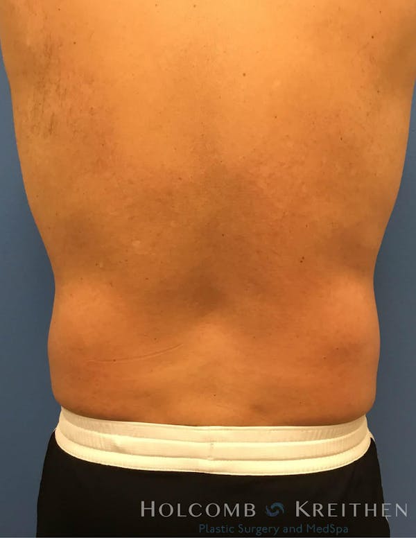 Coolsculpting Gallery - Patient 6279399 - Image 2