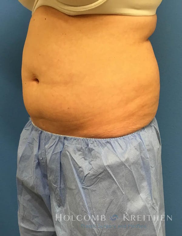 Coolsculpting Before & After Gallery - Patient 6279409 - Image 3