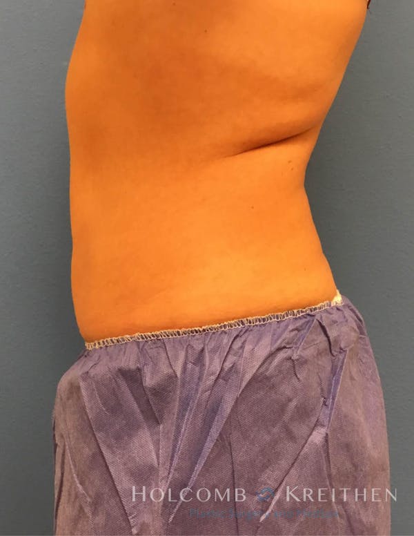 Coolsculpting Before & After Gallery - Patient 6279409 - Image 6