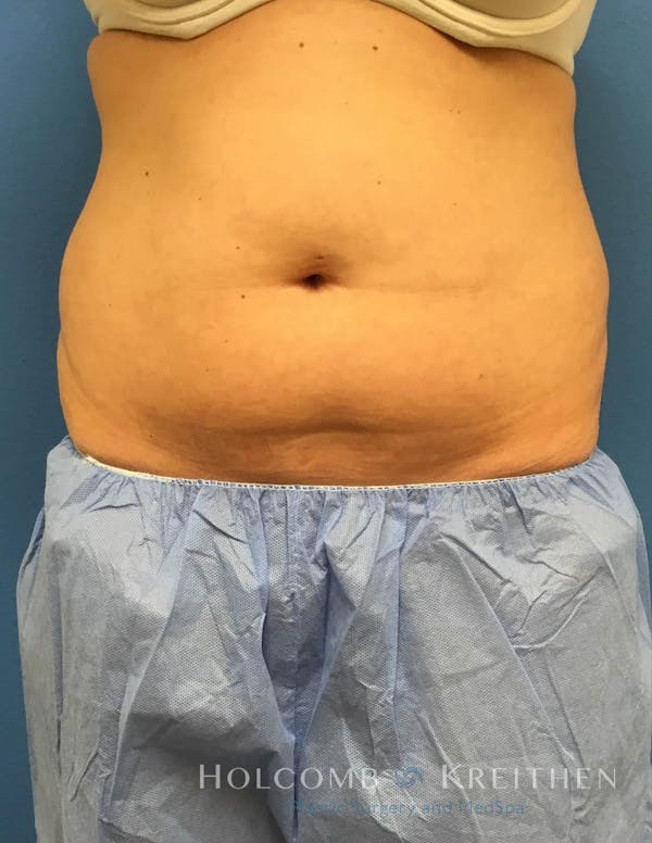Coolsculpting Gallery - Patient 6279409 - Image 1