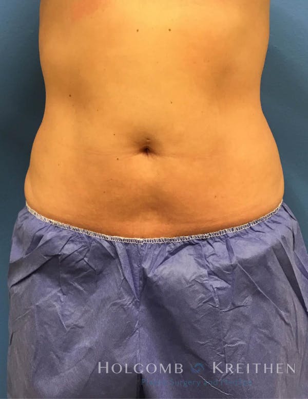 Coolsculpting Before & After Gallery - Patient 6279409 - Image 2