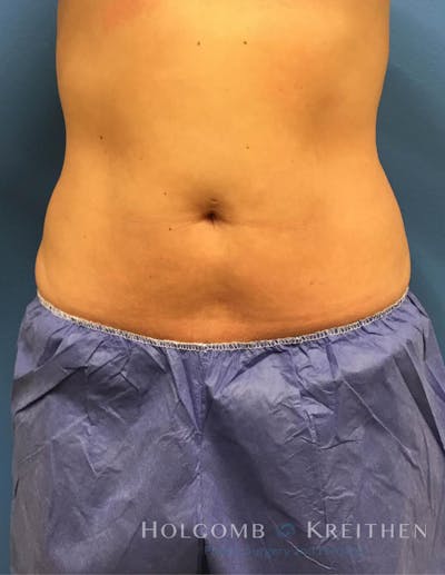 Coolsculpting Before & After Gallery - Patient 6279409 - Image 2