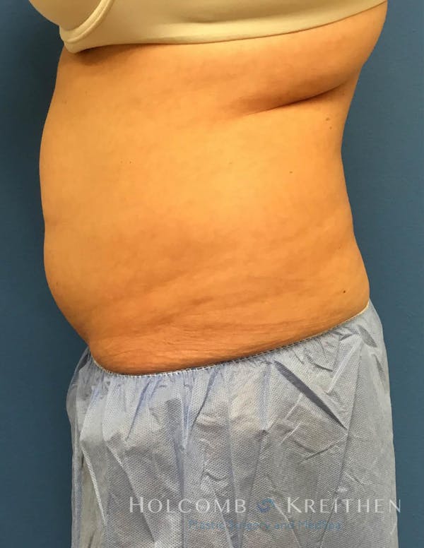 Coolsculpting Before & After Gallery - Patient 6279409 - Image 5