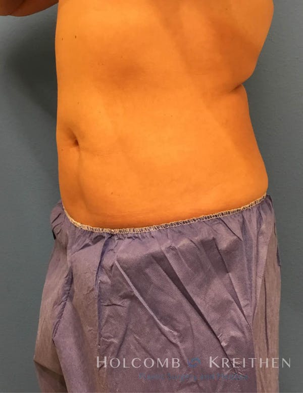 Coolsculpting Before & After Gallery - Patient 6279409 - Image 4
