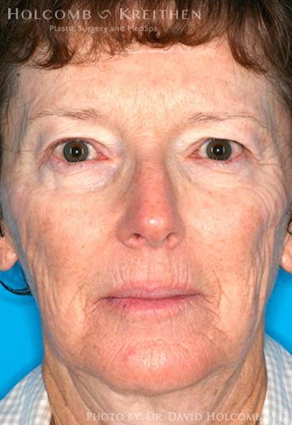 TRL Laser Skin Resurfacing Before & After Gallery - Patient 6279430 - Image 1