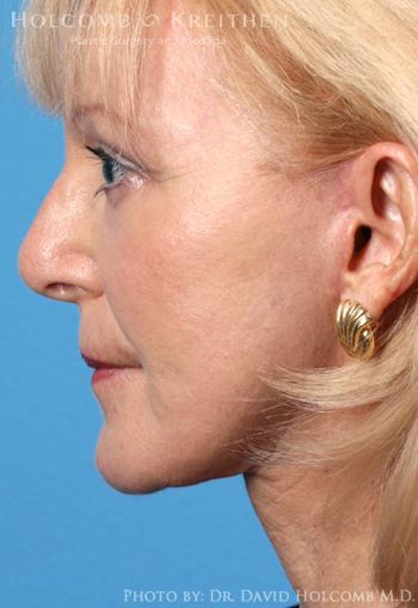 TRL Laser Skin Resurfacing Before & After Gallery - Patient 6279448 - Image 6